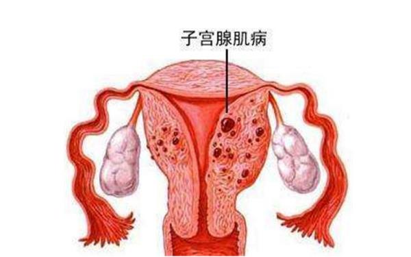 子宫腺肌症可以做试管婴儿吗？
